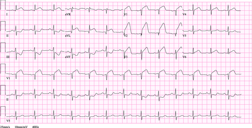 SINDROME CORONARICA ACUTA STEMI