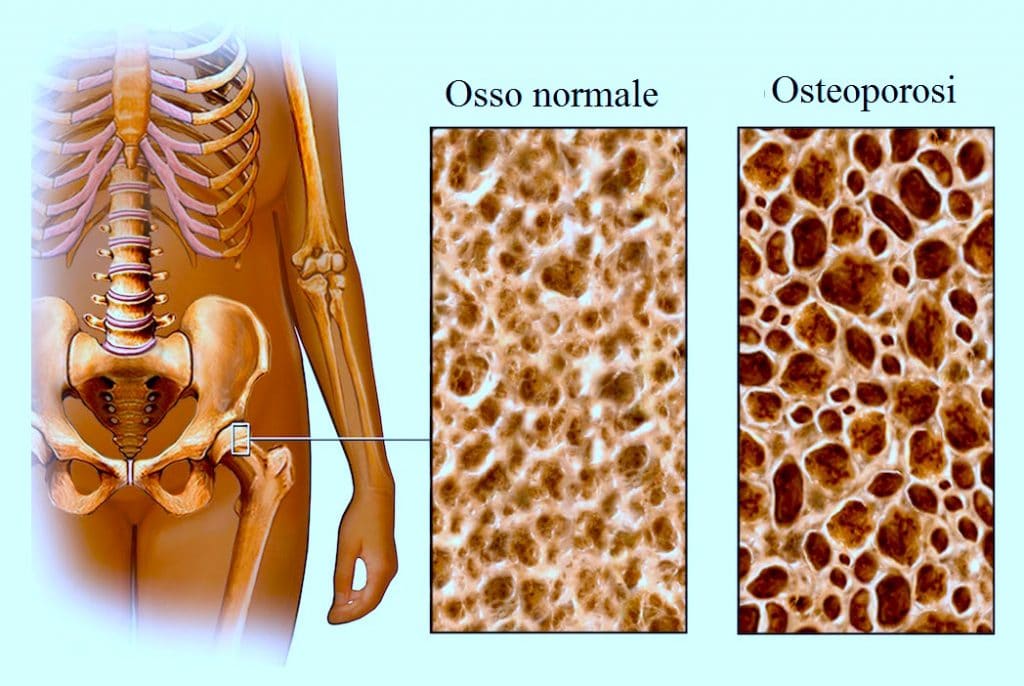 Osteoporosi
