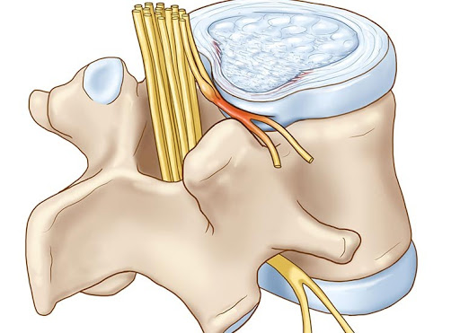 ernia del disco fuoriuscita porzione fibrosa