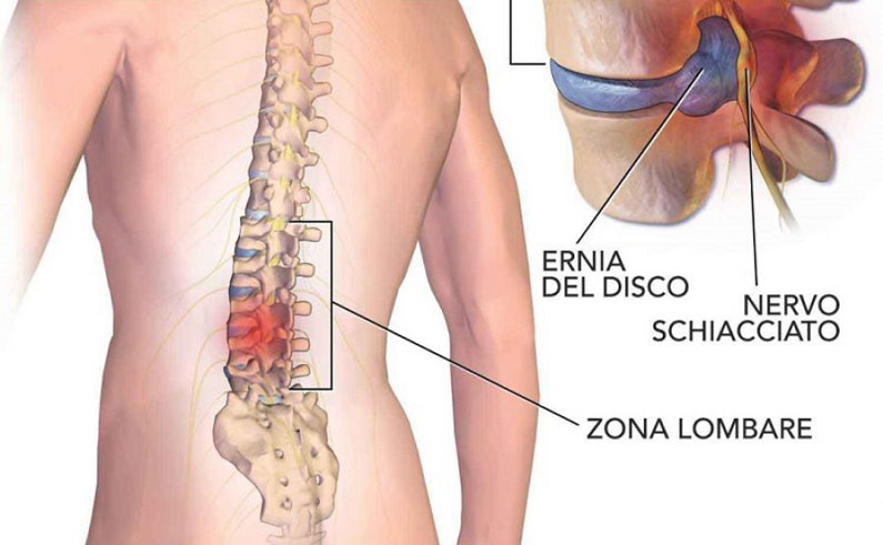 fisioterapia-ernia-del-disco