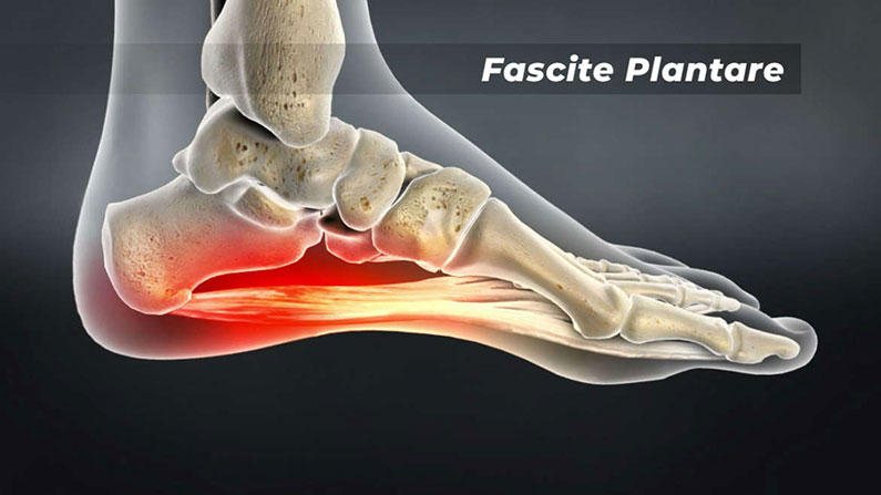 fisioterapia per la fascite plantare