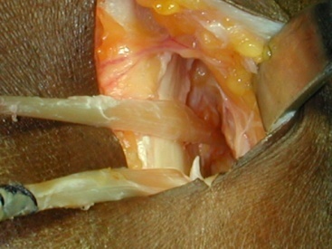 prelievo tendini flessori