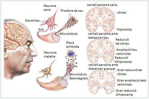 Alzheimer-Cervello