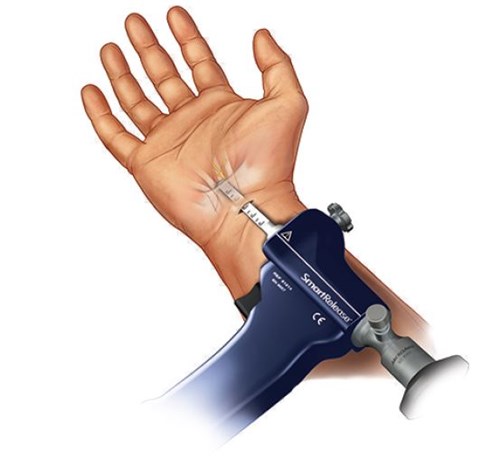 approccio endoscopico tunnel carpale