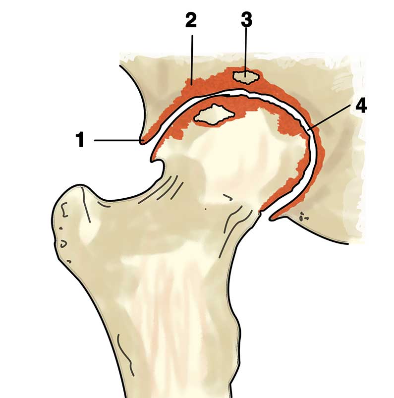 Coxartrosi