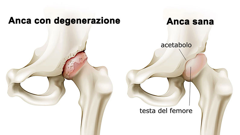 Anca sana e anca con degenerazione