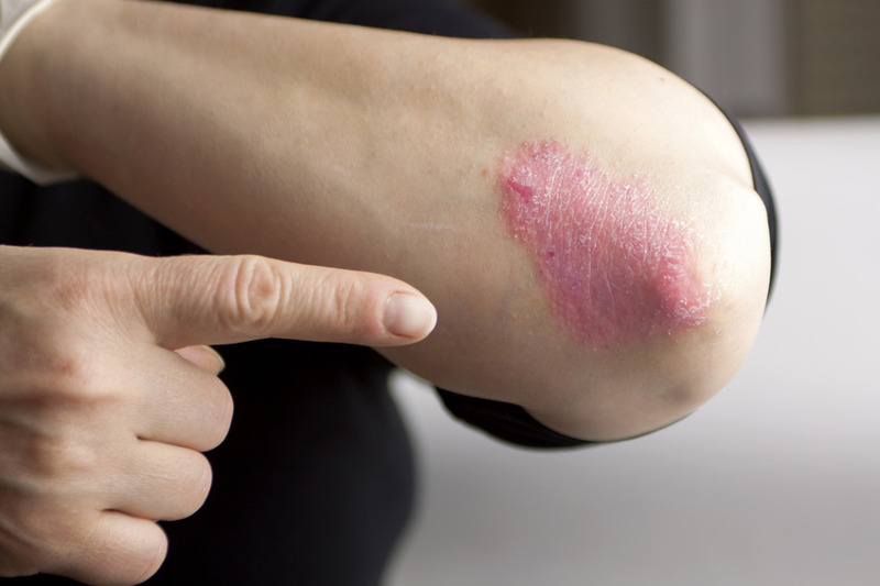 Psoriasi: cos’è, tipologie, cause e cure