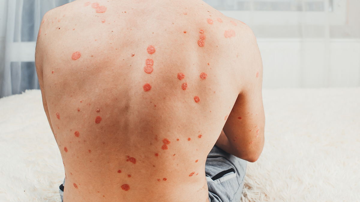 psoriasi guttata