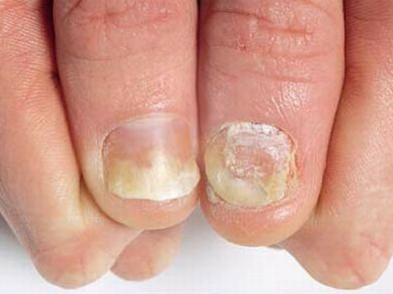 Psoriasi ungueale