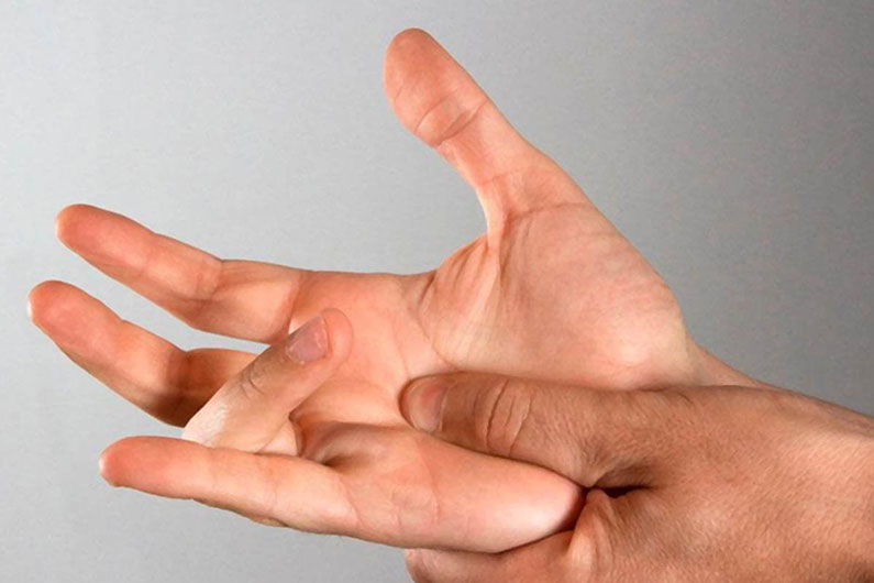 dito a scatto o tenosinovite stenosante