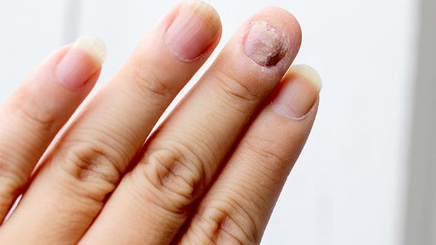 micosi alle unghie delle mani