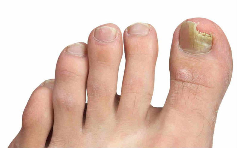 Micosi alle unghie: come riconoscerla, cause e cure