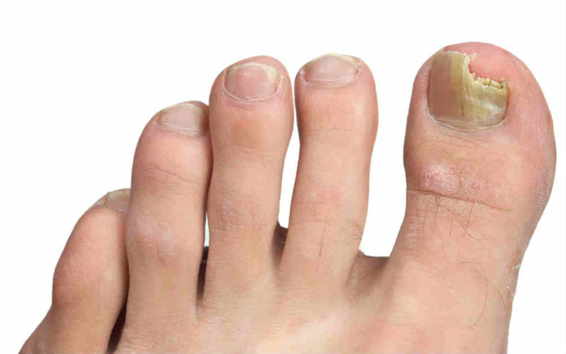 Micosi alle unghie: come riconoscerla, cause e cure - Poliambulatorio ...