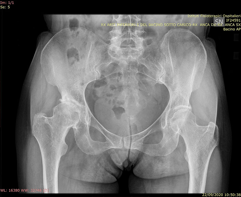 Radiografia preoperatoria paziente con artrosi cronica all'anca radiografia-bacino-paziente-con-artrosi-avanzata-anca-destra