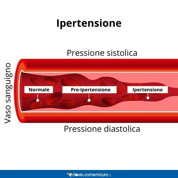 vaso sanguigno con e senza ipertensione