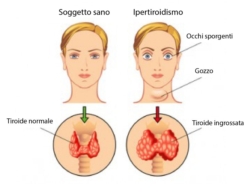 ipertiroidismo