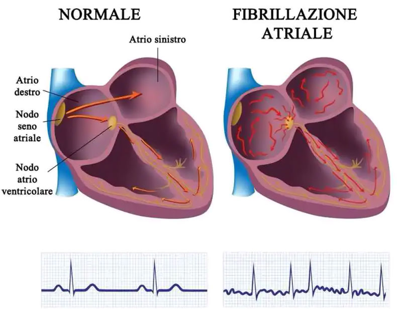Fibrillazione Atriale: cause, sintomi e fattori di rischio