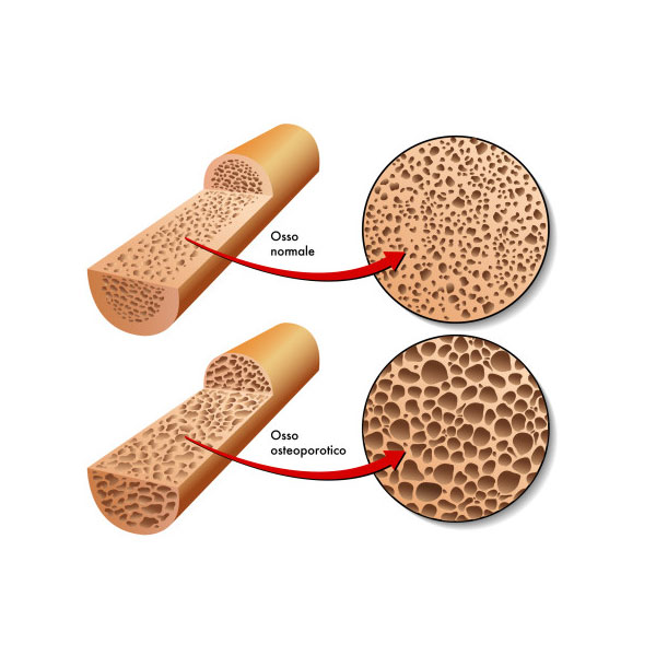 confronto osso sano e osso osteoporotico