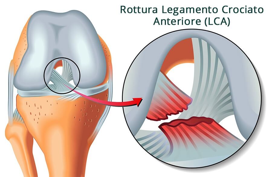 riabilitazione legamento crociato anteriore ginocchio