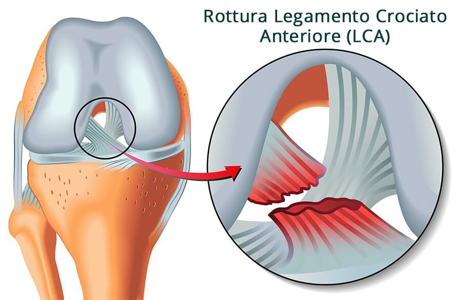 riabilitazione legamento crociato anteiore ginocchio