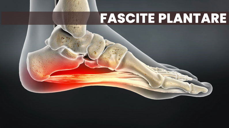Fascite Plantare come trattarla, tra fisioterapia e podologo