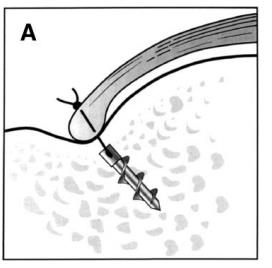 fissaggio tendine cuffia rotatori